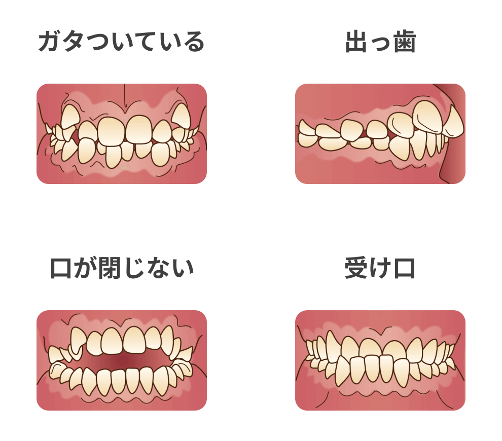 ガタついている 出っ歯 口が閉じない 受け口